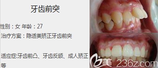 程玲隱形矯正矯正案例
