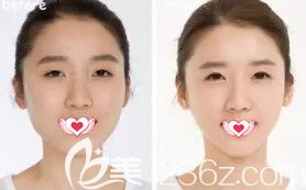 秦皇島巧致注射瘦臉案例