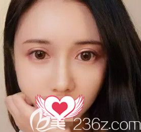 的自體脂肪面部填充術(shù)讓我告別衰老下垂的大媽臉