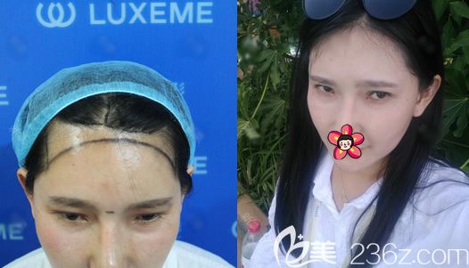 杭州連天美鄭云瑤植發(fā)案例