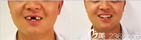 深圳諾德齒科朱俊前門牙缺失2顆種植案例圖