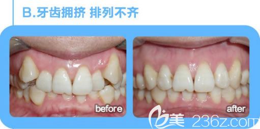 文梁醫(yī)生牙齒擁擠和虎牙矯正后的對(duì)比效果