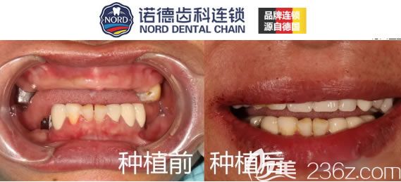 深圳諾德齒科周森半口種植牙案例圖
