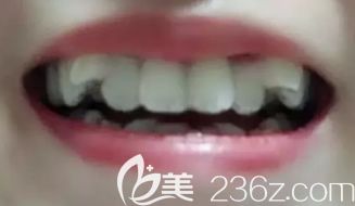 我在<!--<i data=20240703-sp></i>-->做牙齒矯正前的照片 我在<!--<i data=20240703-sp></i>-->做牙齒矯正前的照片