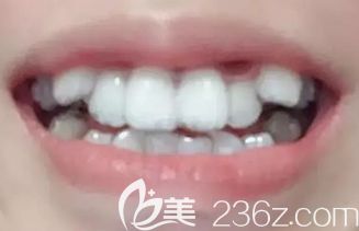 我在<!--<i data=20240703-sp></i>-->做隱形矯正第3個(gè)月 我在<!--<i data=20240703-sp></i>-->做隱形矯正第3個(gè)月