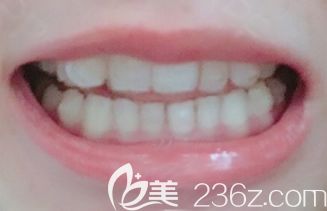 我在<!--<i data=20240703-sp></i>-->做牙齒矯正第12個(gè)月 我在<!--<i data=20240703-sp></i>-->做牙齒矯正第12個(gè)月