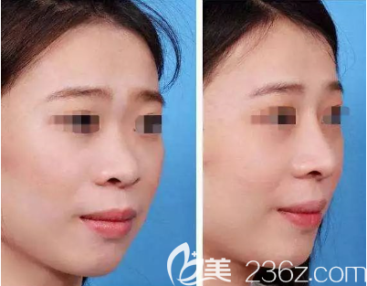 貴陽美貝爾玻尿酸隆鼻案例