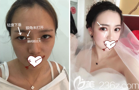 貴陽美貝爾雙眼皮怎么樣