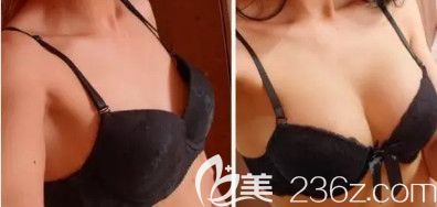 劉遂琦醫(yī)生做隆胸案例 劉遂琦醫(yī)生做隆胸案例