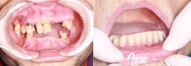 深圳諾德齒科柯明院長(zhǎng)7旬老人即刻種植牙案例 深圳諾德齒科柯明院長(zhǎng)7旬老人即刻種植牙案例