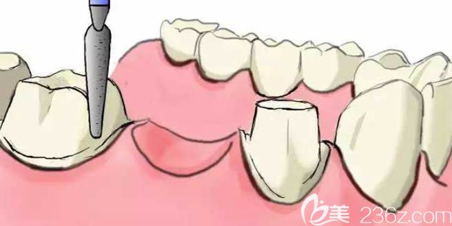 柯明醫(yī)生科普關(guān)于種植牙的知識(shí) 柯明醫(yī)生科普關(guān)于種植牙的知識(shí)