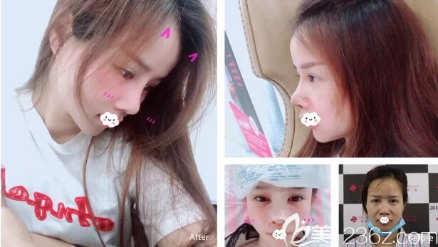 <!--<i data=20240703-sp></li>
?
<li><i data=20240703-sp></i>-->雙眼皮失敗修復(fù)+隆鼻修復(fù)案例恢復(fù)過程