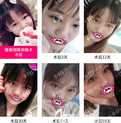 湘潭雅美整形怎么樣，看雙眼皮案例分享