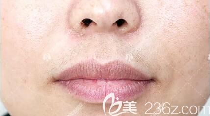 超冰脫唇毛術(shù)前照 超冰脫唇毛術(shù)前照