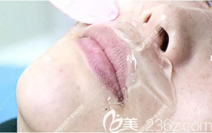 超冰脫唇毛術(shù)前涂脫毛專用冷凍凝膠 超冰脫唇毛術(shù)前涂脫毛專用冷凍凝膠