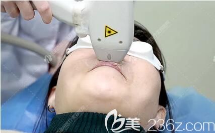 超冰脫唇毛手術(shù)過(guò)程中 超冰脫唇毛手術(shù)過(guò)程中