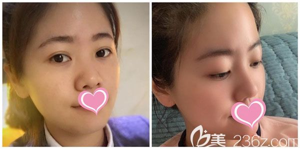 王德寧玻尿酸隆鼻真人案例 王德寧玻尿酸隆鼻真人案例