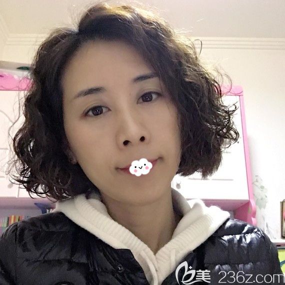 眼窩凹陷十分顯老,朋友建議我到整形做自體脂肪填充眼窩案例恢復(fù)過程