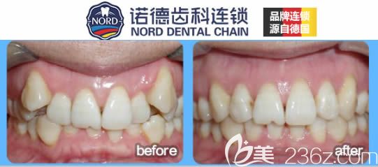 深圳諾德齒科成人隱適美虎牙矯正前后對比效果