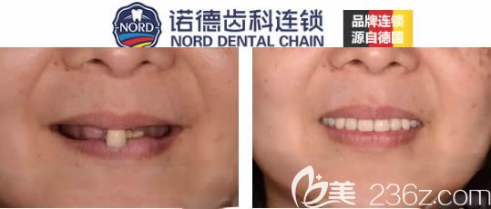 諾德口腔allon4種植牙真實(shí)案例