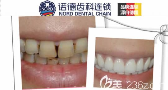 深圳諾德連鎖全瓷牙修復(fù)前后對比照