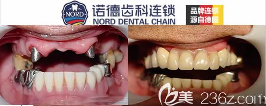 諾德齒科75歲老人戴精密附著體活動假牙對比效果
