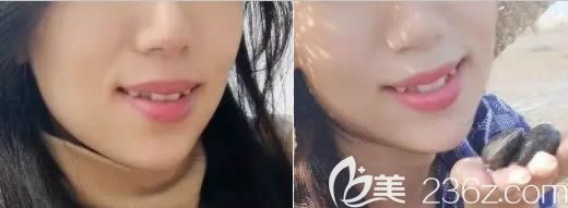 在深圳諾德齒科做牙齒矯正前的樣子 在深圳諾德齒科做牙齒矯正前的樣子