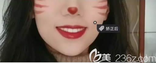 35歲矯正牙齒成功分享!我在深圳諾德齒科戴隱適美隱形牙套12個(gè)月后改善了露齒笑和虎牙