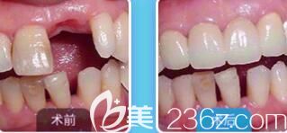 西安海濤口腔靠譜嗎？海濤趙葛孟單顆牙既可種植案例效果公布