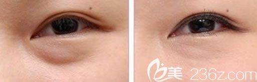 永康光大整形醫(yī)院消除眼袋案例