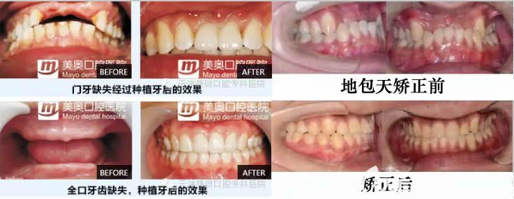天津美奧種植牙及牙齒矯正案例效果 天津美奧種植牙及牙齒矯正案例效果