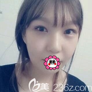 <!--<i data=20240703-sp></i>-->面部填充20天效果