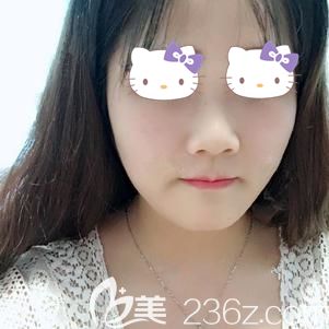 注射瘦臉除皺瘦臉術(shù)后7天沒(méi)有出現(xiàn)過(guò)敏現(xiàn)象 注射瘦臉除皺瘦臉術(shù)后7天沒(méi)有出現(xiàn)過(guò)敏現(xiàn)象