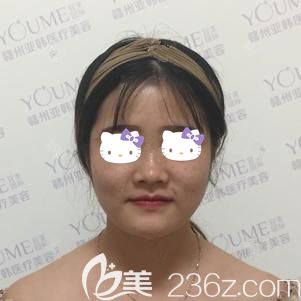 到贛州亞韓醫(yī)療美容醫(yī)院面診前大餅?zāi)樀奈? alt=