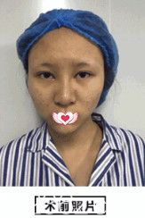 在邢臺美加美做眼鼻綜合術(shù)前是內(nèi)雙和塌鼻子 在邢臺美加美做眼鼻綜合術(shù)前是內(nèi)雙和塌鼻子