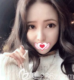 邢臺美加美陳譽華院長做眼鼻綜合術(shù)后25天恢復(fù)情況 邢臺美加美陳譽華院長做眼鼻綜合術(shù)后25天恢復(fù)情況