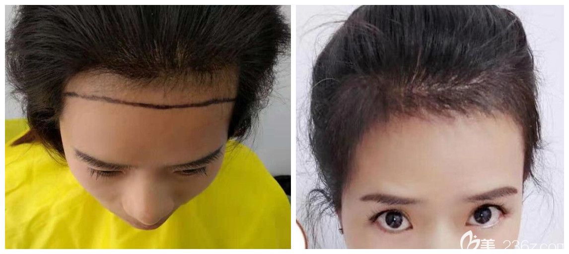 合肥植發(fā)醫(yī)院哪個好？公布合肥壹美尚方蜜女性發(fā)際線種植案例