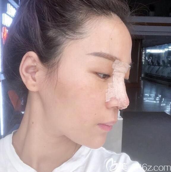 找胡準(zhǔn)做假體隆鼻+耳軟骨墊鼻尖術(shù)后天 找胡準(zhǔn)做假體隆鼻+耳軟骨墊鼻尖術(shù)后天