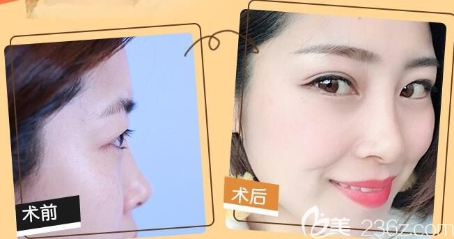 合肥鼻綜合哪家好？白領(lǐng)安琪兒胡準(zhǔn)鼻綜合隆鼻案例效果一覽