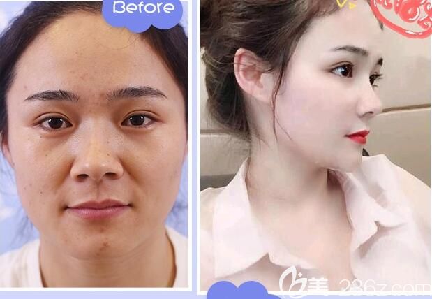 合肥安琪兒全臉埋線提升案例