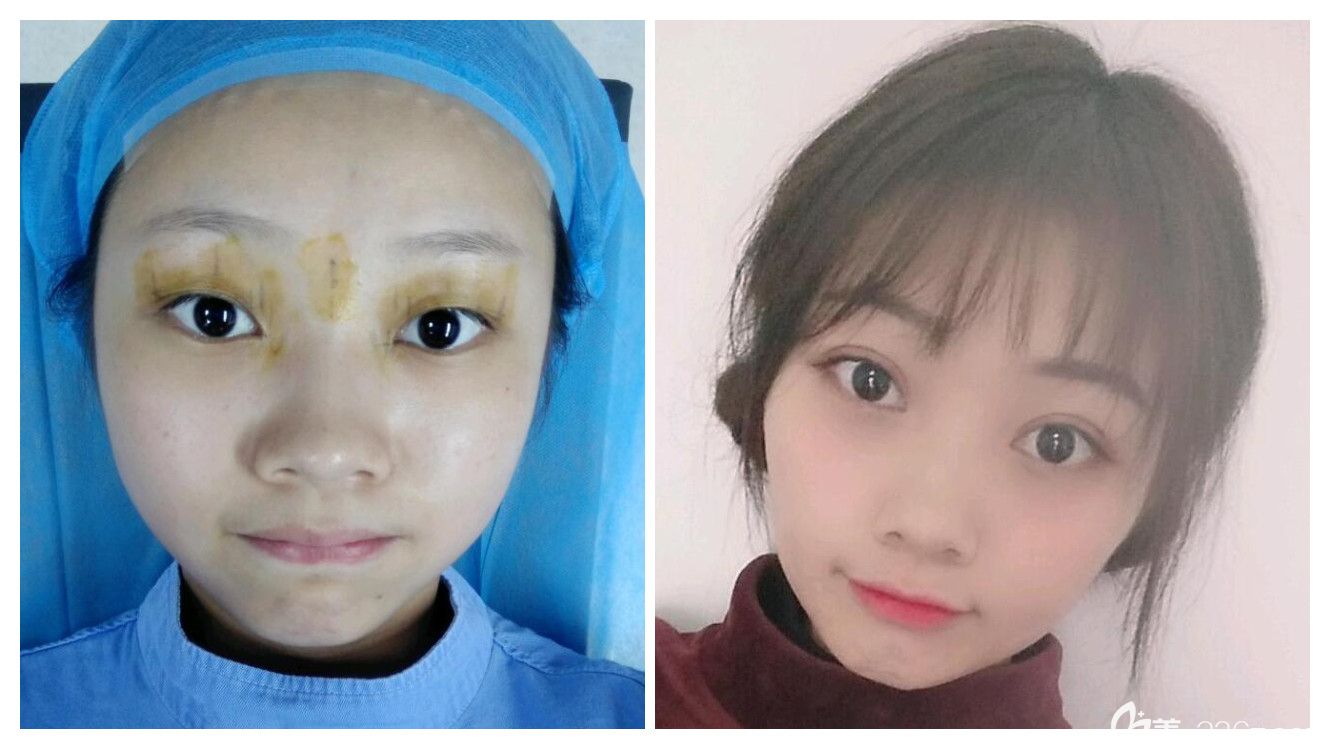 合肥哪里割雙眼皮好？合肥白領(lǐng)安琪兒眼綜合案例效果對比圖