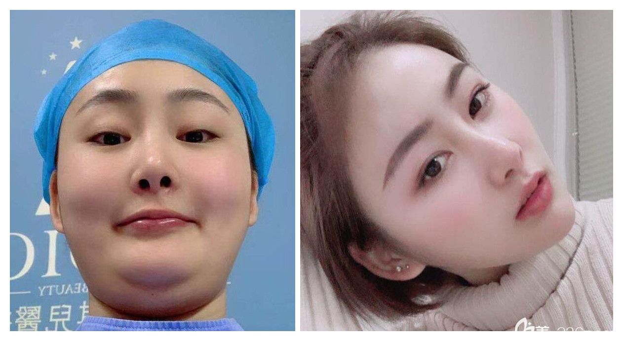 合肥白領(lǐng)安琪兒面部抽脂對比照
