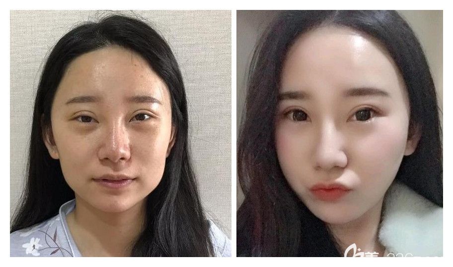 面部自體脂肪填充好嗎？合肥安琪兒自體脂肪全臉填充案例公布