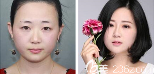 重慶愛思特整形雙眼皮怎么樣