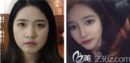 重慶愛思特隆鼻好不好