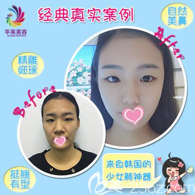 華美整形醫(yī)院隆鼻案例