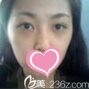 上饒尚美醫(yī)療美容門診部面診前面部凹陷的我 上饒尚美醫(yī)療美容門診部面診前面部凹陷的我