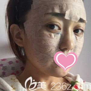 劉育鳳主任做自體脂肪面部填充術(shù)后即刻 劉育鳳主任做自體脂肪面部填充術(shù)后即刻