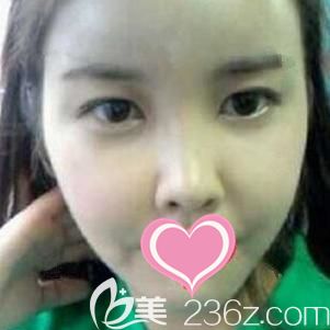 做自體脂肪全面部填充術(shù)后10天面部淤青腫脹消除 做自體脂肪全面部填充術(shù)后10天面部淤青腫脹消除