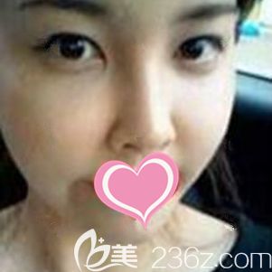 在上饒尚美整形做自體脂肪面部填充術(shù)后20天脂肪基本存活 在上饒尚美整形做自體脂肪面部填充術(shù)后20天脂肪基本存活